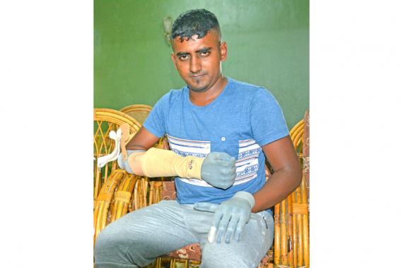 Les prothèses d’Aslam Noursing ont coûté plus de Rs 2 millions. 