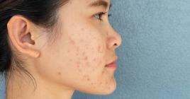 L’acné peut avoir un impact aussi bien physique que moral.